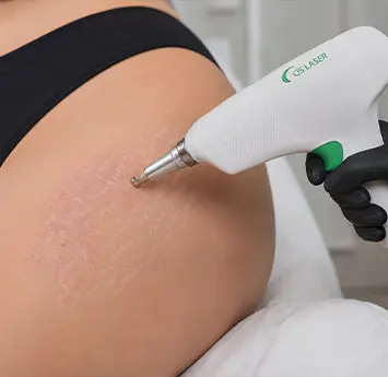 Laser Scar Removal