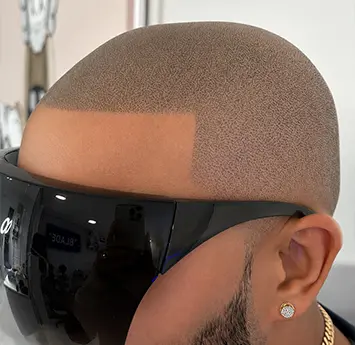 Scalp Micropigmentation (SMP)
